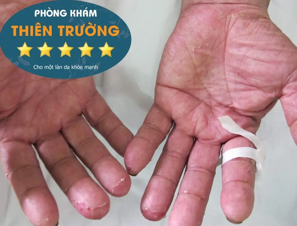Hình ảnh: Viêm da cơ địa ở tay