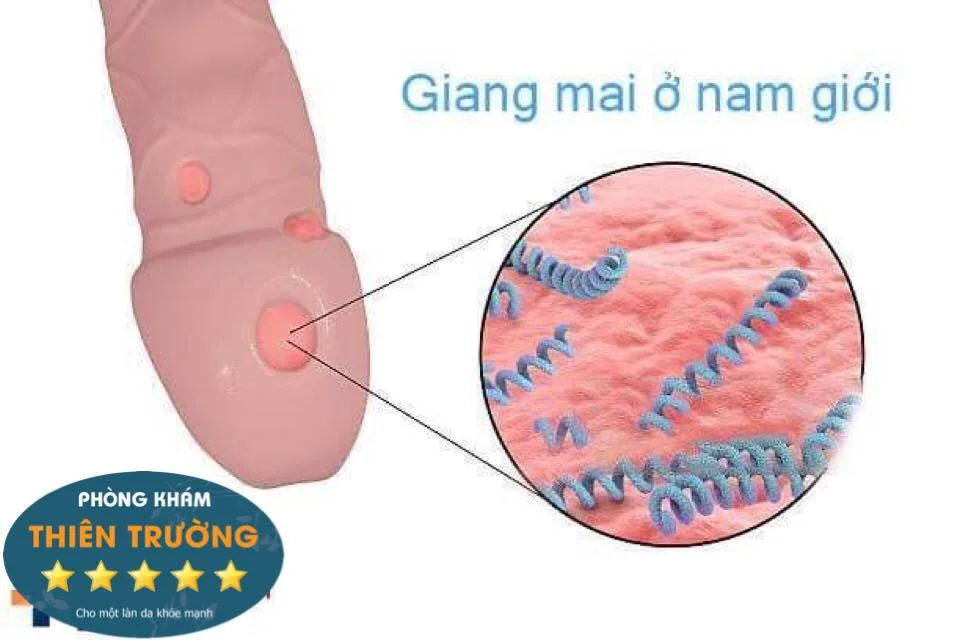 Hình ảnh: Giang mai ở nam