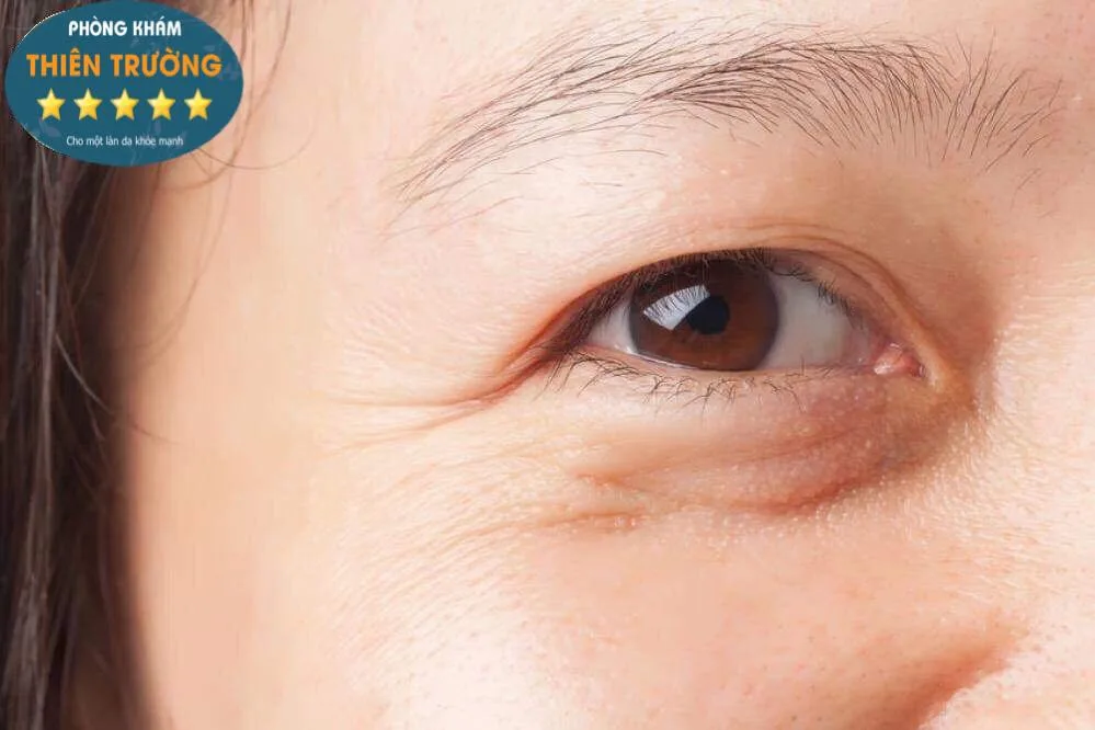 Hình ảnh: Rãnh nhăn và nếp nhăn