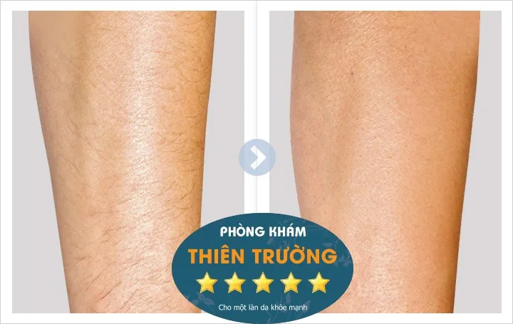 Hình ảnh: Trước và sau khi triệt lông