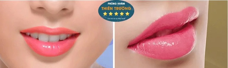 Hình ảnh: Phun - Xăm môi tại phòng khám Da liễu Thẩm mỹ Thiên Trường