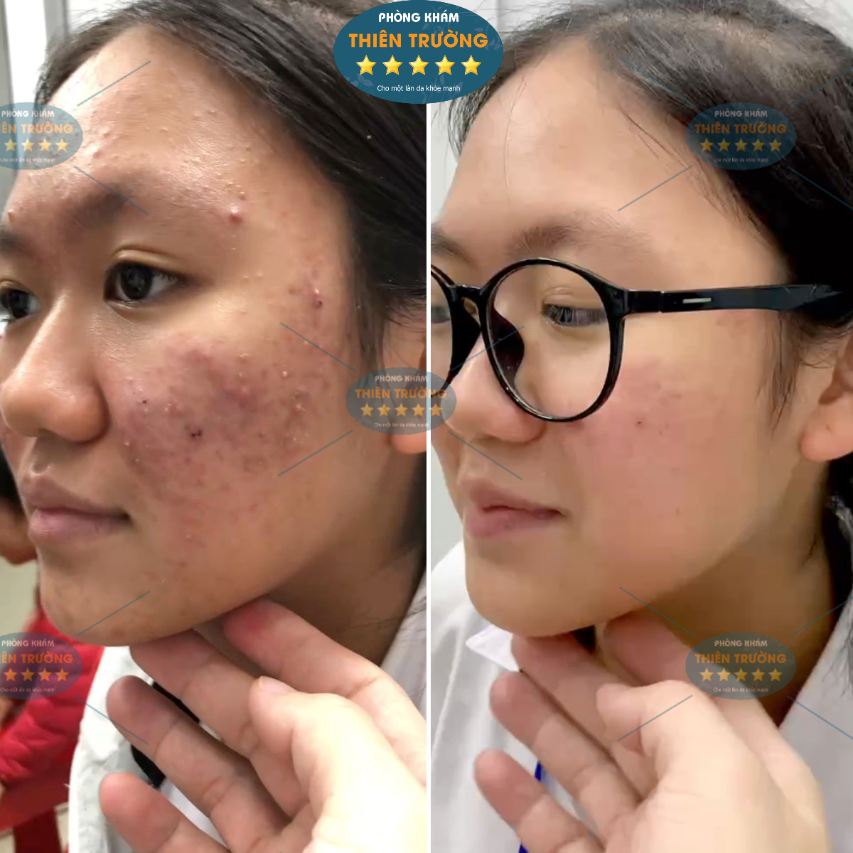 Hình ảnh : Bệnh nhân đã điều trị tại Phòng khám Da liễu Thiên Trường