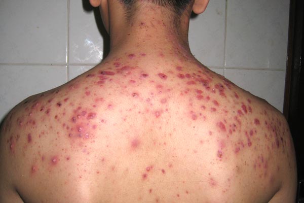 Mụn-trứng-cá-vùng-lưng-nguy-cơ-để-lại-sẹo-lồi