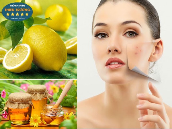 Hình ảnh: Hỗ trợ điều trị thâm mụn bằng thiên nhiên