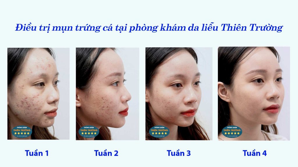 Hình ảnh : bệnh nhân đã điều trị mụn trứng cá tại Phòng khám da liễu Thẩm Mỹ Thiên Trường