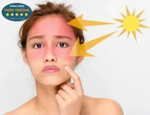 Hình ảnh: Nguyên nhân gây nám, tàn nhang