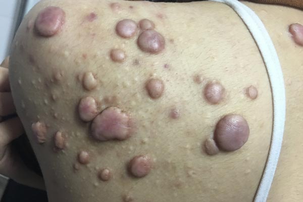 sẹo-lồi-vai,-lưng-do-điều-trị-mụn-trứng-cá-muộn