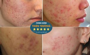 Hình ảnh: Mụn tại vùng mặt