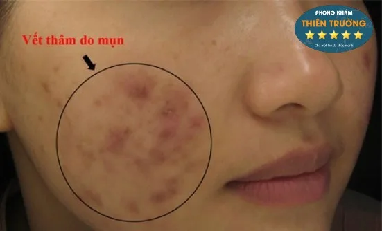 Hình ảnh: Hậu quả điều trị mụn không đúng cách