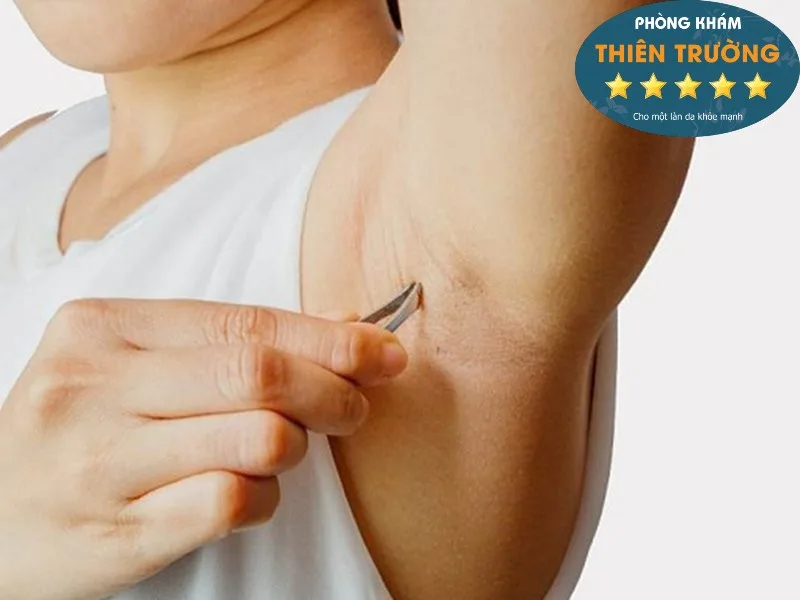 Hình ảnh: Triệt lông bằng phương pháp truyền thống