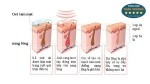 Hình ảnh: Cơ chế hoạt động của công nghệ triệt lông Laser Diode