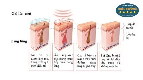 Hình ảnh: Cơ chế hoạt động của công nghệ triệt lông Laser Diode
