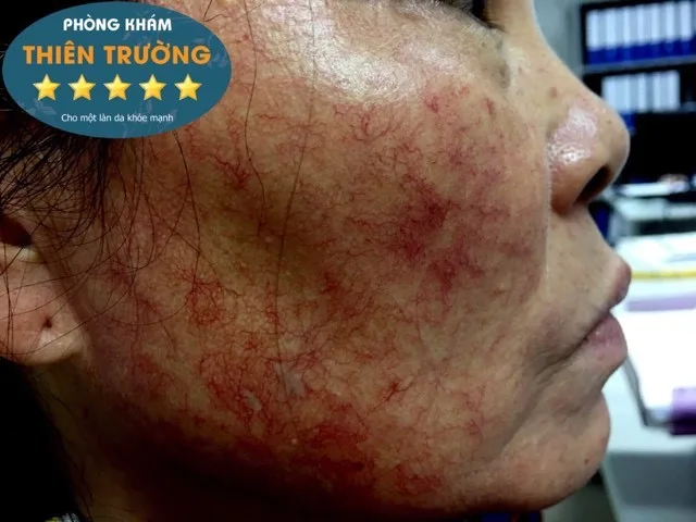 Hình ảnh: Giãn mao mạch do dùng kem trộn