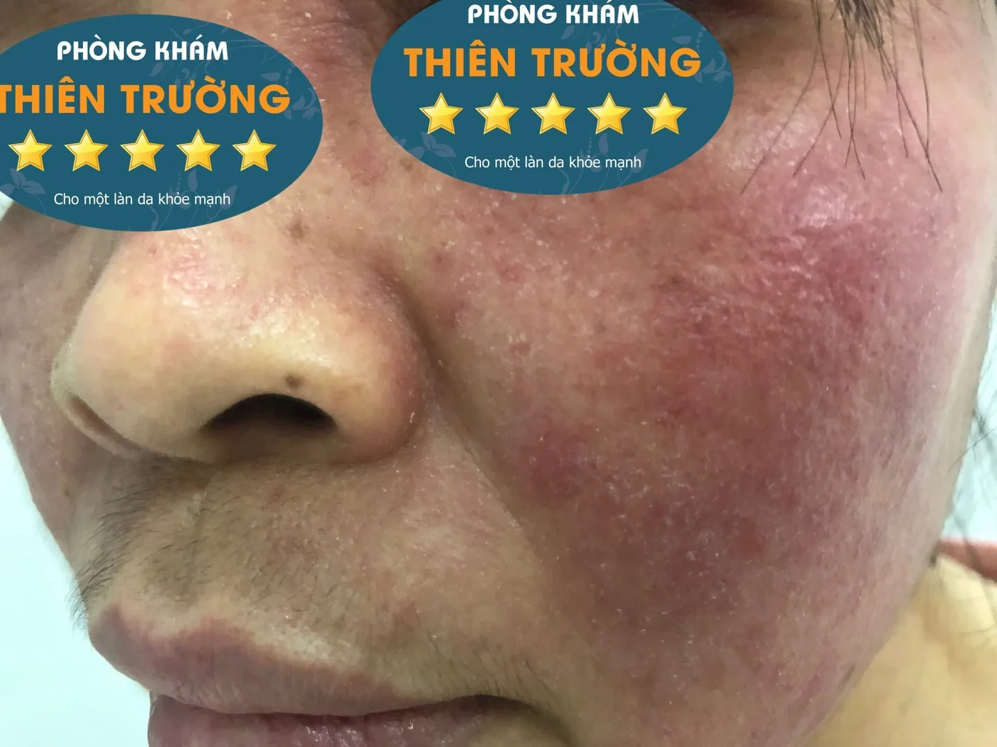 Hình ảnh: Hỏng da do dùng kem trộn