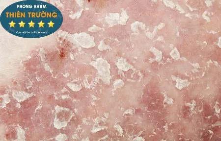 Hình ảnh: Hạn chế làm tổn thương da và khô da