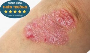 Hình ảnh: Vảy nến mảng