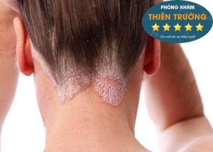 Hình ảnh: Vảy nến