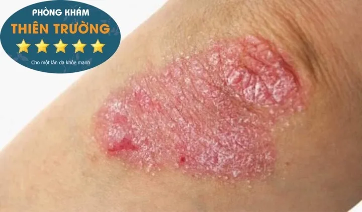 Hình ảnh: Vảy nến mảng