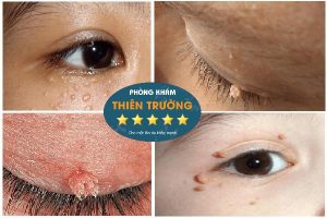 Hình ảnh: Sùi mào gà ở mắt