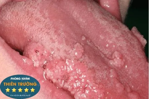 Hình ảnh: Sùi mào gà ở lưỡi