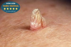 Hình ảnh: Sùi mào gà