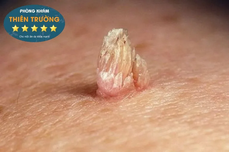 Hình ảnh: Sùi mào gà