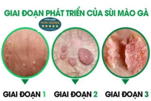 Hình ảnh: Giai đoạn phát triển sùi mào gà