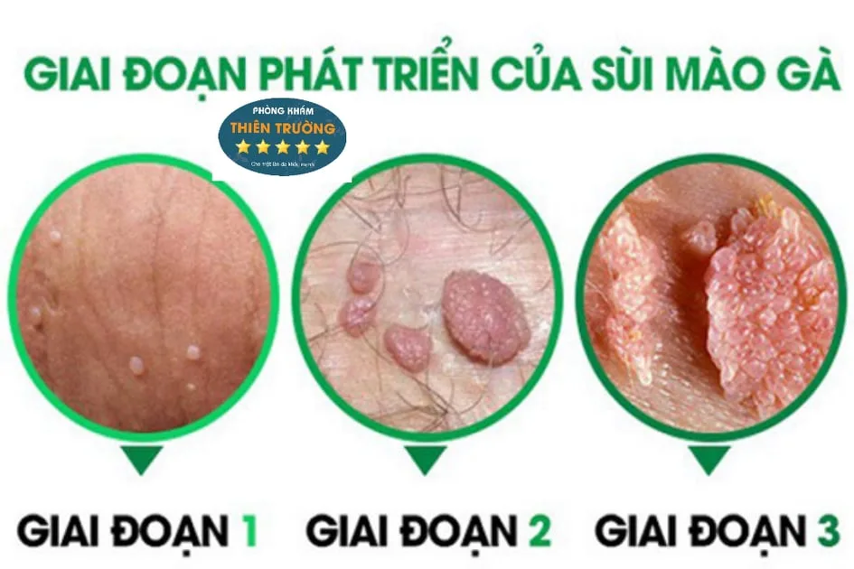 Hình ảnh: Giai đoạn phát triển sùi mào gà
