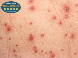 Hình ảnh: Thủy đậu