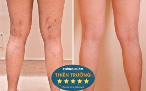 Hình ảnh: Trước và sau khi điều trị giãn mao mạch ở chân