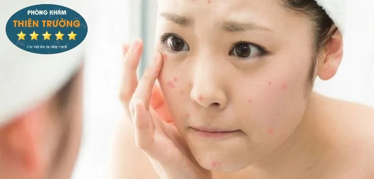 Hình ảnh: Không nên chạm tay lên da mặt đang bị mụn