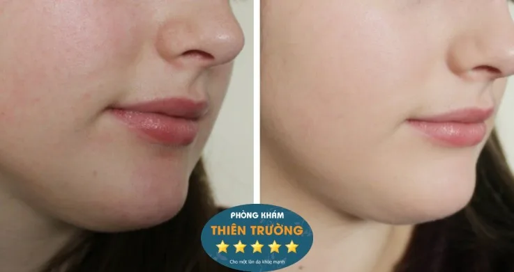 Hình ảnh: Trước và sau khi điều trị giãn mao mạch