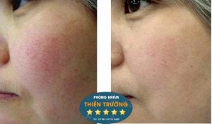 Hình ảnh: Trước và sau khi điều trị giãn mao mạch