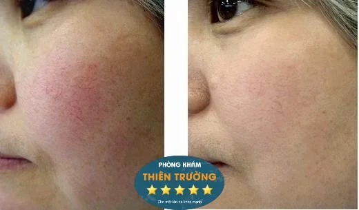Hình ảnh: Trước và sau khi điều trị giãn mao mạch