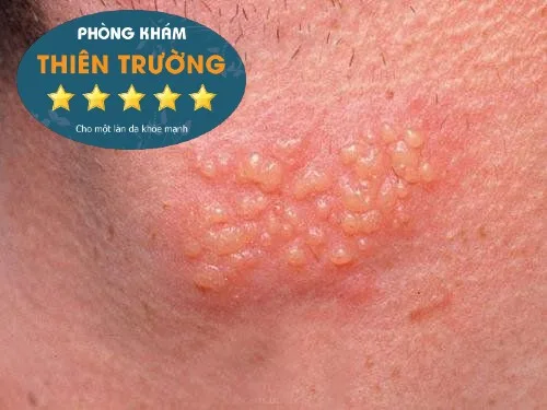 Hình ảnh: Biểu hiện của sùi mào gà