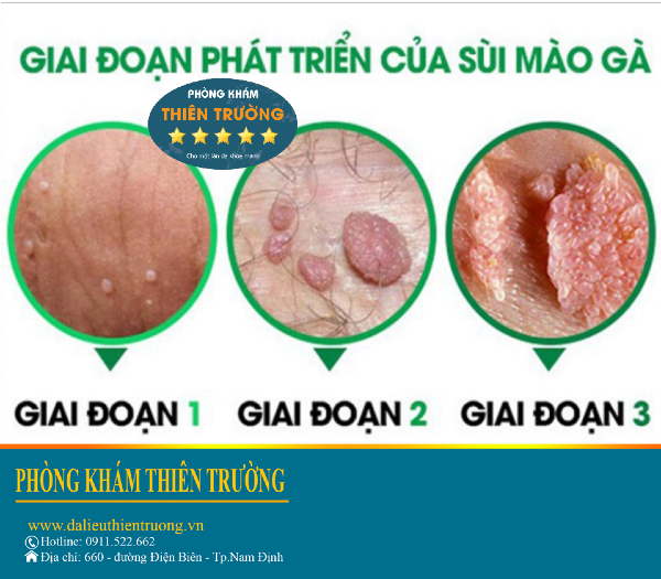 Những lưu ý khi điều trị mụn cơm hoa liễu