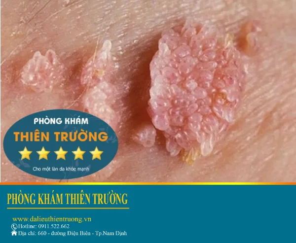 Hình ảnh: Sùi mào gà