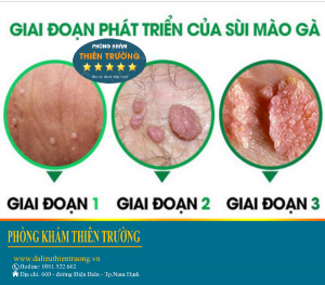 Hình ảnh: Giai đoạn phát triển của sùi mào gà