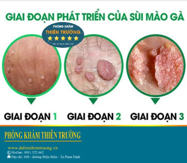 Hình ảnh: Giai đoạn phát triển của sùi mào gà