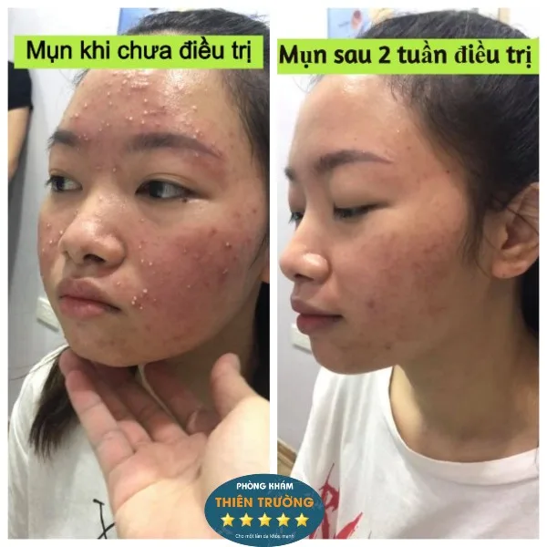 Hình ảnh: Trước và sau khi điều trị mụn tại Phòng khám Da liễu thẩm mỹ Thiên Trường