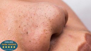 Hình ảnh: Mụn đầu đen