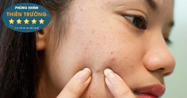 Hình ảnh: Không nên sờ tay lên mặt và tự nặn mụn tại nhà.