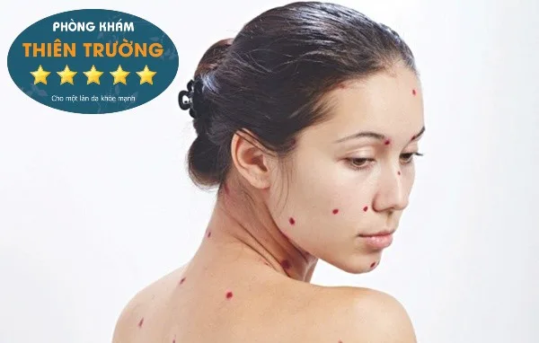 Hình ảnh: Thủy đậu