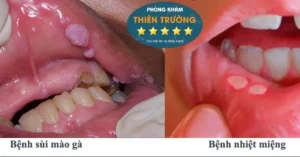Hình ảnh: Phân biệt sùi mào gà và nhiệt miệng