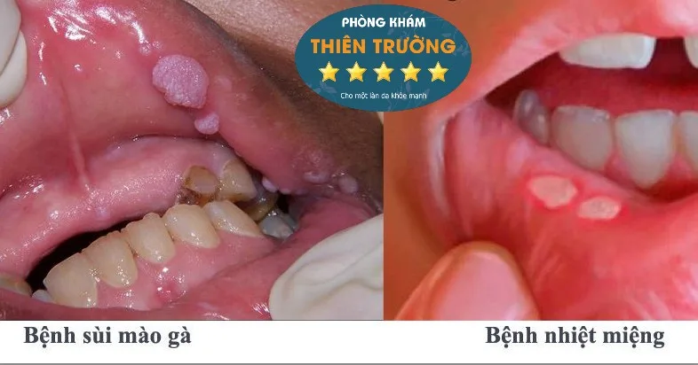 Hình ảnh: Phân biệt sùi mào gà và nhiệt miệng