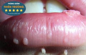 Hình ảnh: Sùi mào gà ở môi