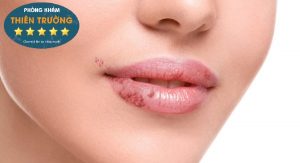 Hình ảnh: Mụn cóc sinh dục ở miệng