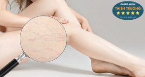Hình ảnh: Giãn mao mạch ở chân