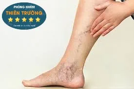 Hình ảnh: Giãn mao mạch chân