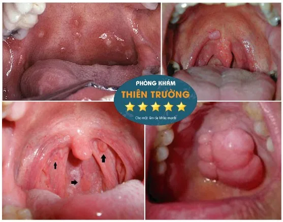 Hình ảnh: Sùi mào gà ở họng